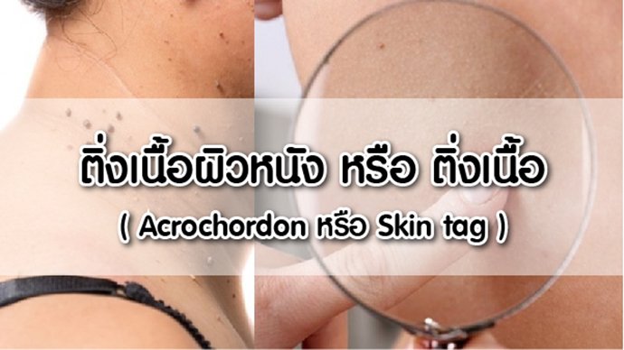 ติ่งเนื้อผิวหนัง หรือ ติ่งเนื้อ (Acrochordon หรือ Skin tag )