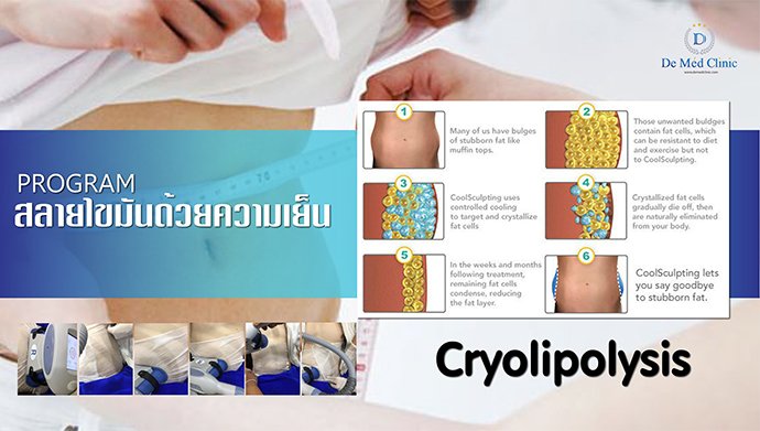สลายไขมันด้วยความเย็น Cryolipolysis สลายไขมันด้วยความเย็น Cryolipolysis