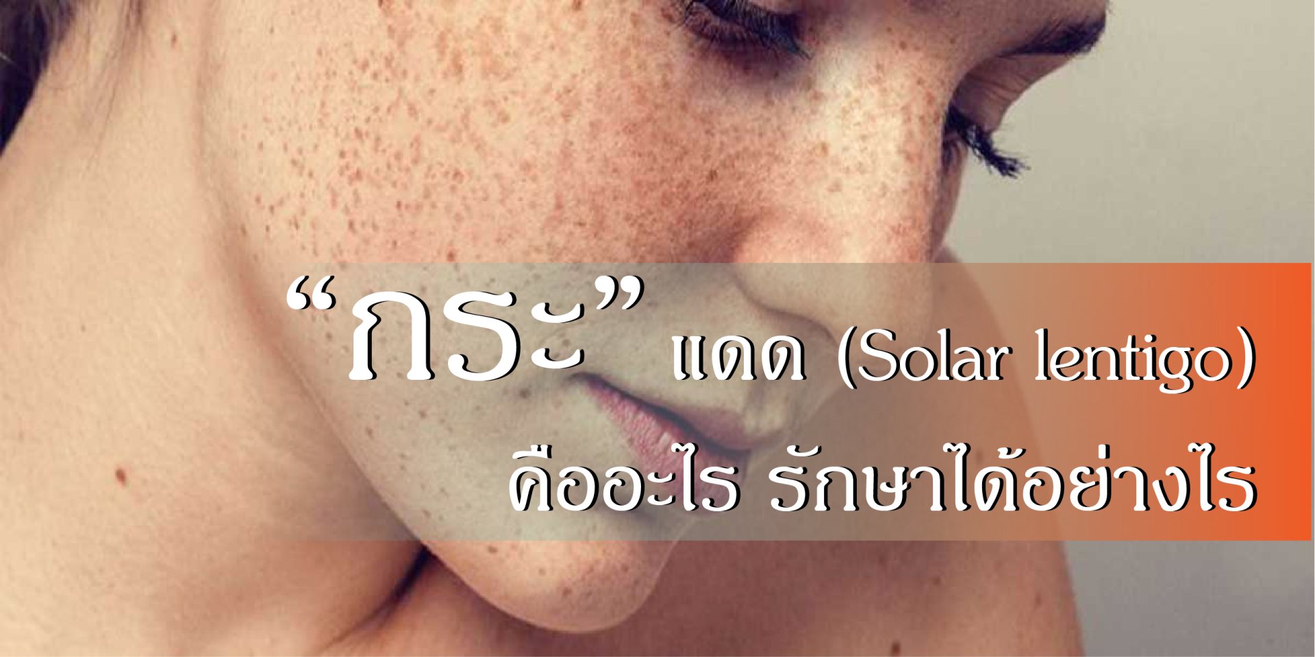 กระแดด (Solar lentigo) คืออะไร รักษาได้อย่างไร 