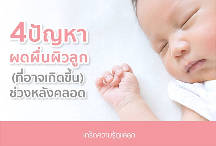 4 ปัญหาผดผื่นผิวลูก (ที่อาจเกิดขึ้น) ช่วงหลังคลอด 4 ปัญหาผดผื่นผิวลูก (ที่อาจเกิดขึ้น) ช่วงหลังคลอด