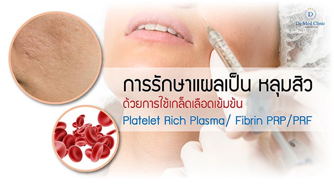 การรักษา แผลเป็น หลุมสิวด้วยการใช้เกล็ดเลือดเข้มข้น Platelet Rich Plasma/ Fibrin PRP/PRF  การรักษา แผลเป็น หลุมสิวด้วยการใช้เกล็ดเลือดเข้มข้น Platelet Rich Plasma/ Fibrin PRP/PRF