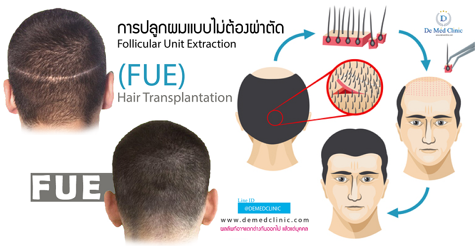 การปลูกผมแบบไม่ต้องผ่าตัด Follicular Unit Extraction (FUE) Hair Transplantation  การปลูกผมแบบไม่ต้องผ่าตัด Follicular Unit Extraction (FUE) Hair Transplantation