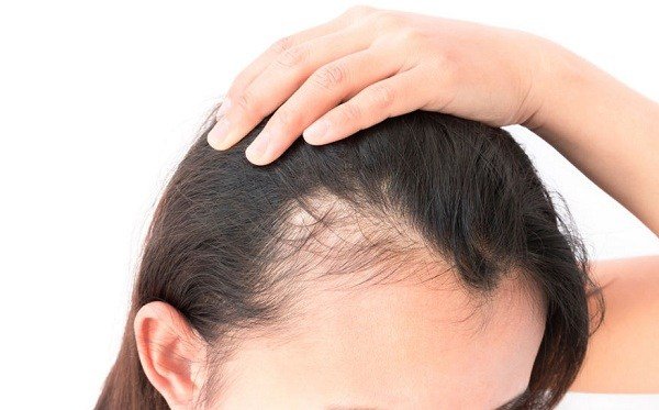 โรคผมร่วงเป็นหย่อม (Alopecia areata) คืออะไร???