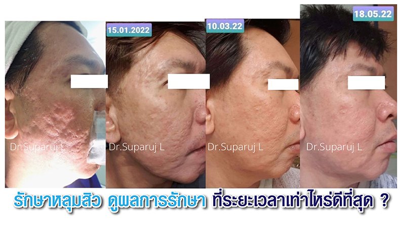 รักษาหลุมสิว ดูผลการรักษา ที่ระยะเวลาเท่าไหร่ดีที่สุด ? รักษาหลุมสิว ดูผลการรักษา ที่ระยะเวลาเท่าไหร่ดีที่สุด ?