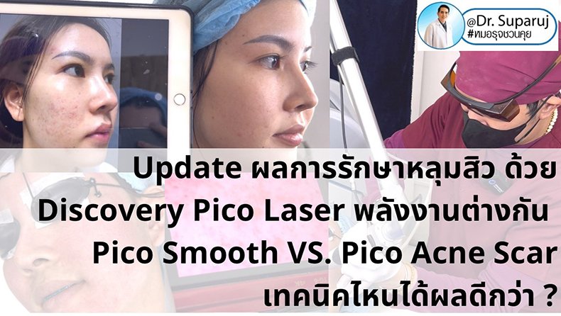 Update ผลการรักษาหลุมสิว ด้วย Discovery Pico Laser พลังงานต่างกัน Pico Smooth (Moderate Fluence) VS. Pico Acne Scar (High Fluence)เทคนิคไหนได้ผลดีกว่า ?  Update ผลการรักษาหลุมสิว ด้วย Discovery Pico Laser พลังงานต่างกัน Pico Smooth (Moderate Fluence) VS. Pico Acne Scar (High Fluence)เทคนิคไหนได้ผลดีกว่า ?