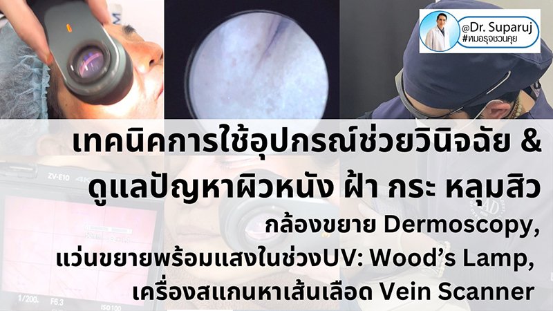 เทคนิคการใช้อุปกรณ์ช่วยวินิจฉัย & ดูแลปัญหาผิวหนัง ฝ้า กระ หลุมสิว: กล้องขยาย Dermoscopy, แว่นขยายพร้อมแสงในช่วงUV: Wood’s Lamp, เครื่องสแกนหาเส้นเลือด Vein Scanner เทคนิคการใช้อุปกรณ์ช่วยวินิจฉัย & ดูแลปัญหาผิวหนัง ฝ้า กระ หลุมสิว: กล้องขยาย Dermoscopy, แว่นขยายพร้อมแสงในช่วงUV: Wood’s Lamp, เครื่องสแกนหาเส้นเลือด Vein Scanner