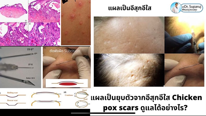 แผลเป็นยุบตัวจากอีสุกอีใส Chicken pox scars ดูแลได้อย่างไร ? แผลเป็นยุบตัวจากอีสุกอีใส Chicken pox scars ดูแลได้อย่างไร ?