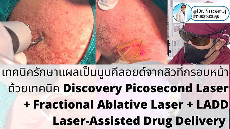 แนะนำเทคนิคดูแลแผลเป็นนูนคีลอยด์: รักษาแผลเป็นนูนคีลอยด์จากสิวที่กรอบหน้าด้วยเทคนิค Discovery Picosecond Laser + Fractional Ablative Laser + LADD Laser-Assisted Drug Delivery  แนะนำเทคนิคดูแลแผลเป็นนูนคีลอยด์: รักษาแผลเป็นนูนคีลอยด์จากสิวที่กรอบหน้าด้วยเทคนิค Discovery Picosecond Laser + Fractional Ablative Laser + LADD Laser-Assisted Drug Delivery