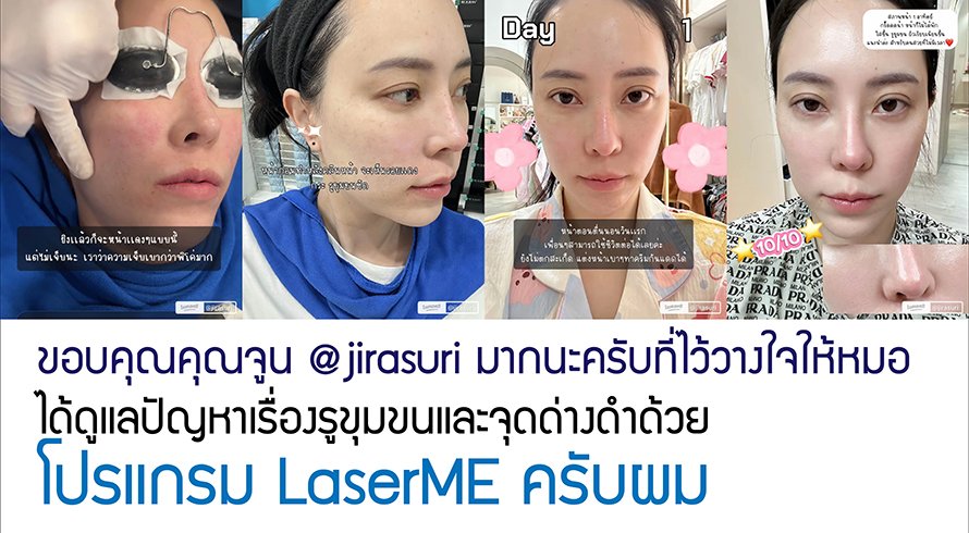 ขอบคุณคุณจูน @jirasuri มากนะครับที่ไว้วางใจให้หมอได้ดูแลปัญหาเรื่องรูขุมขนและจุดด่างดำด้วย โปรแกรม LaserME ครับผม