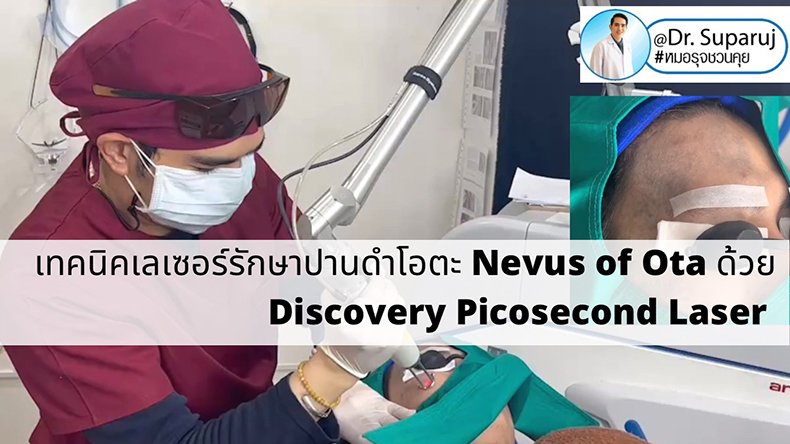 เทคนิคเลเซอร์รักษาปานดำโอตะ Nevus of Ota ด้วย Discovery Picosecond Laser เลเซอร์ปานดำ l หมอรุจชวนคุย เทคนิคเลเซอร์รักษาปานดำโอตะ Nevus of Ota ด้วย Discovery Picosecond Laser เลเซอร์ปานดำ l หมอรุจชวนคุย