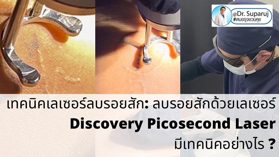 แนะนำเทคนิคเลเซอร์ลบรอยสักด้วย Picosecond Laser: ลบรอยสักด้วยเลเซอร์ Discovery Picosecond Laser มีเทคนิคอย่างไร ? แนะนำเทคนิคเลเซอร์ลบรอยสักด้วย Picosecond Laser: ลบรอยสักด้วยเลเซอร์ Discovery Picosecond Laser มีเทคนิคอย่างไร ?