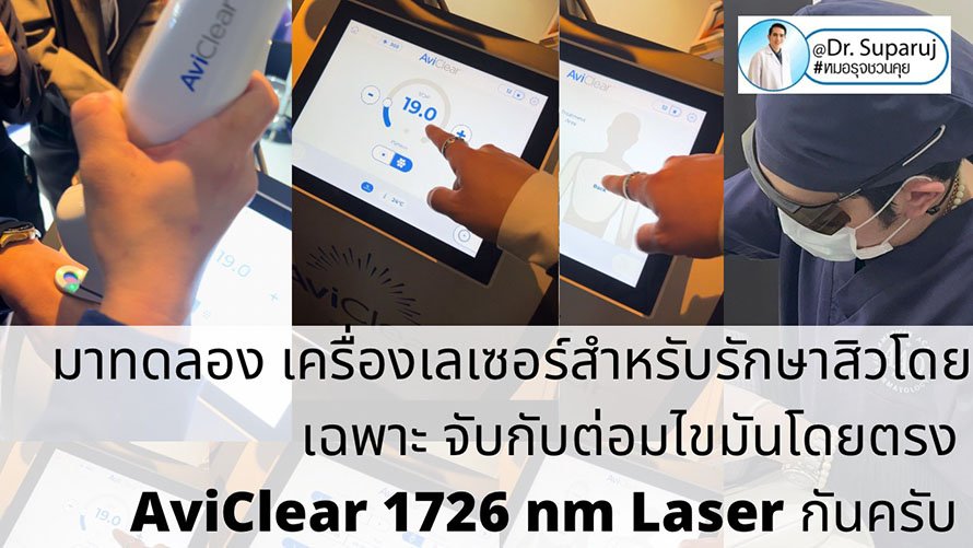 Update เครื่องเลเซอร์สำหรับรักษาสิวโดยเฉพาะ จับกับต่อมไขมันโดยตรง = AviClear 1726 nm Laser Update เครื่องเลเซอร์สำหรับรักษาสิวโดยเฉพาะ จับกับต่อมไขมันโดยตรง = AviClear 1726 nm Laser