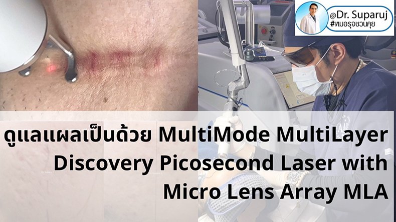 เทคนิคดูแลแผลเป็นด้วยเทคนิค MultiMode MultiLayer Discovery Picosecond Laser with Micro Lens Array MLA เทคนิคดูแลแผลเป็นด้วยเทคนิค MultiMode MultiLayer Discovery Picosecond Laser with Micro Lens Array MLA