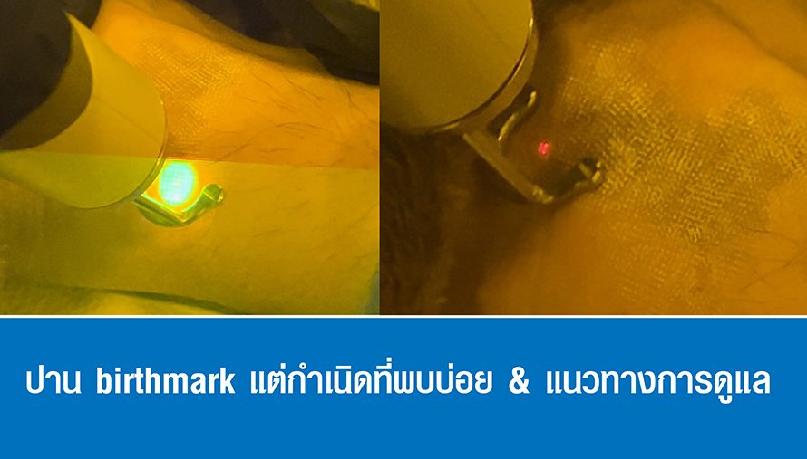 ปาน birthmark แต่กำเนิดที่พบบ่อย & แนวทางการดูแล ปาน birthmark แต่กำเนิดที่พบบ่อย & แนวทางการดูแล