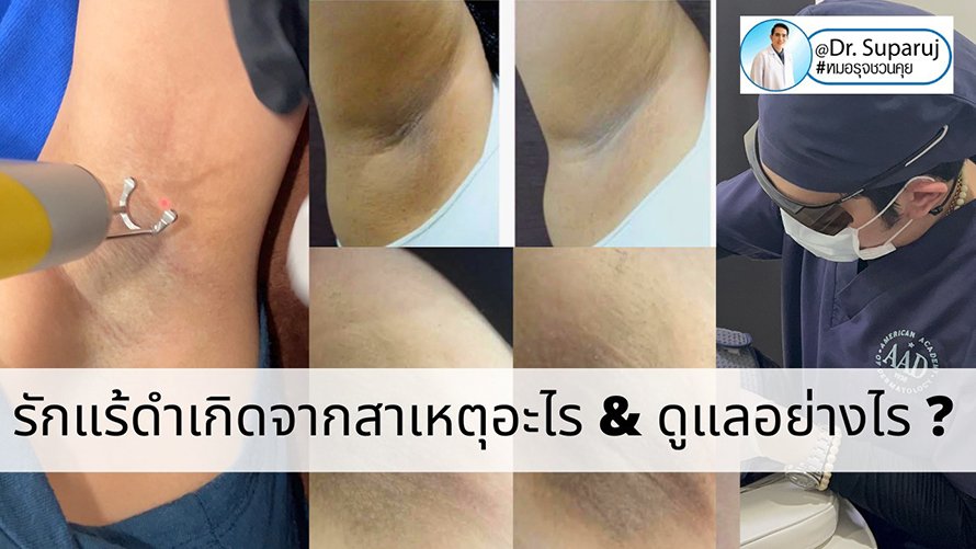 รักแร้ดำเกิดจากสาเหตุอะไร & ดูแลอย่างไร ? รักแร้ดำเกิดจากสาเหตุอะไร & ดูแลอย่างไร ?