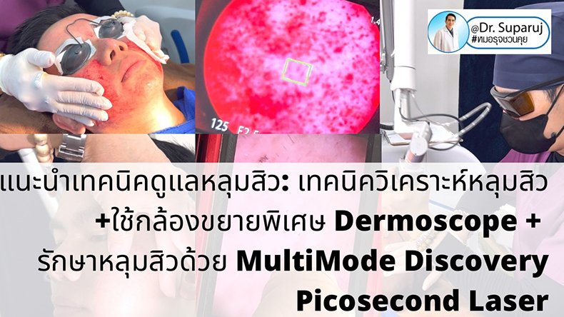 แนะนำเทคนิคดูแลหลุมสิว: เทคนิควิเคราะห์หลุมสิว +ใช้กล้องขยายพิเศษ Dermoscope + รักษาหลุมสิวด้วย MultiMode Discovery Picosecond Laser + Exosome Therapy แนะนำเทคนิคดูแลหลุมสิว: เทคนิควิเคราะห์หลุมสิว +ใช้กล้องขยายพิเศษ Dermoscope + รักษาหลุมสิวด้วย MultiMode Discovery Picosecond Laser + Exosome Therapy