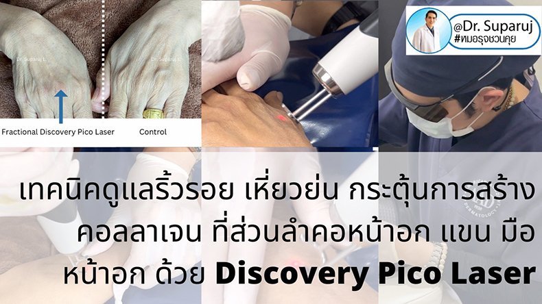 เทคนิคดูแลริ้วรอย เหี่ยวย่น กระตุ้นการสร้างคอลลาเจน ที่ส่วนลำคอหน้าอก แขน มือ หน้าอก ด้วย Discovery Pico Laser เทคนิคดูแลริ้วรอย เหี่ยวย่น กระตุ้นการสร้างคอลลาเจน ที่ส่วนลำคอหน้าอก แขน มือ หน้าอก ด้วย Discovery Pico Laser