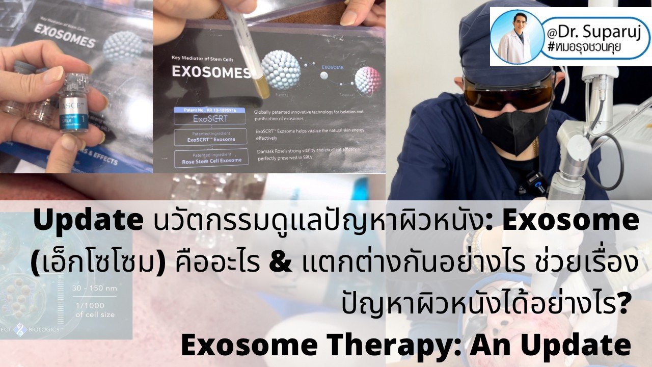 แนะนำเทคนิคในการดูแลหลุมสิว: Exosome ใน การรักษาหลุมสิว (Exosome & acne scar treatment) แนะนำเทคนิคในการดูแลหลุมสิว: Exosome ใน การรักษาหลุมสิว (Exosome & acne scar treatment)