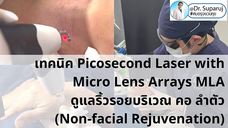 แนะนำ เทคนิคการใช้เลเซอร์ Picosecond Laser with Micro Lens Arrays MLA เพื่อดูแลริ้วรอยบริเวณ คอ ลำตัว (Non-facial rejuvenation) แนะนำ เทคนิคการใช้เลเซอร์ Picosecond Laser with Micro Lens Arrays MLA เพื่อดูแลริ้วรอยบริเวณ คอ ลำตัว (Non-facial rejuvenation)