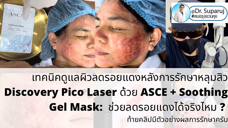 เทคนิคดูแลผิวลดรอยแดงหลังการรักษาหลุมสิว Discovery Pico Laser ด้วย ASCE + Soothing Gel Mask: ช่วยลดรอยแดงได้จริงไหม ? (ท้ายคลิปมีตัวอย่างผลการรักษาครับ)