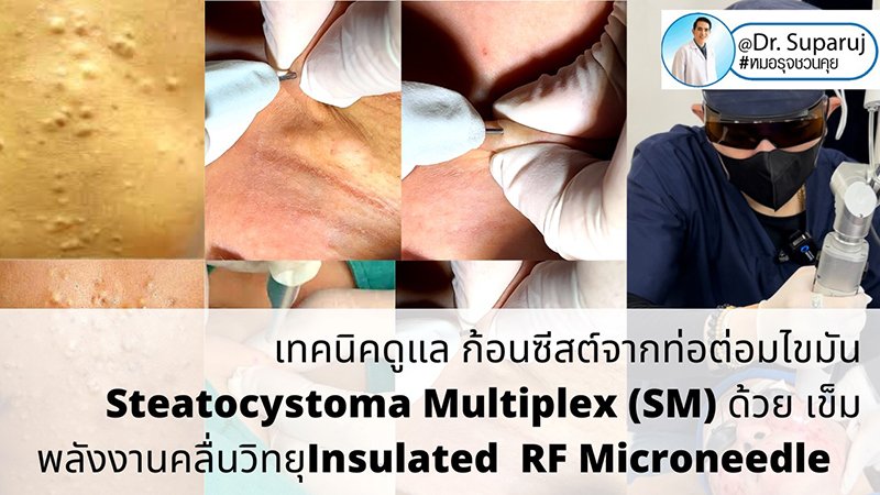 แนะนำเทคนิคดูแล ก้อนซีสต์จากท่อต่อมไขมัน Steatocystoma Multiplex (SM) ด้วย เข็มพลังงานคลื่นวิทยุ Insulated Radiofrequency RF Microneedle for Steatocystoma Multiplex Treatment แนะนำเทคนิคดูแล ก้อนซีสต์จากท่อต่อมไขมัน Steatocystoma Multiplex (SM) ด้วย เข็มพลังงานคลื่นวิทยุ Insulated Radiofrequency RF Microneedle for Steatocystoma Multiplex Treatment