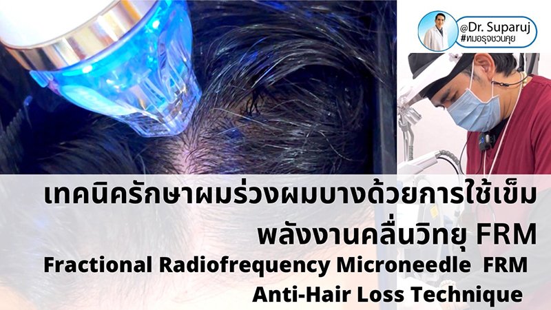 แนะนำเทคนิครักษาผมร่วงผมบาง: เทคนิครักษาผมร่วงผมบางด้วยการใช้เข็มพลังงานคลื่นวิทยุ Fractional Radiofrequency Microneedle FRM Anti-Hair Loss Technique