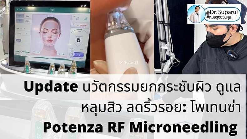 Update นวัตกรรมยกกระชับผิว ดูแลหลุมสิว ลดริ้วรอย: Potenza RF Microneedling โพเทนซ่า Update นวัตกรรมยกกระชับผิว ดูแลหลุมสิว ลดริ้วรอย: Potenza RF Microneedling โพเทนซ่า