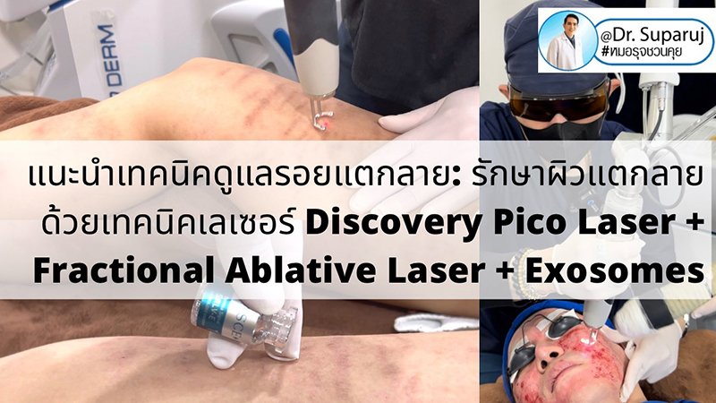 แนะนำเทคนิคดูแลรอยแตกลาย: รักษาผิวแตกลายด้วยเทคนิคเลเซอร์ Discovery Pico Laser + Fractional Ablative Laser + Exosomes แนะนำเทคนิคดูแลรอยแตกลาย: รักษาผิวแตกลายด้วยเทคนิคเลเซอร์ Discovery Pico Laser + Fractional Ablative Laser + Exosomes
