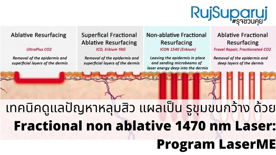 เทคนิคดูแลปัญหาหลุมสิว แผลเป็น รูขุมขนกว้าง ด้วย Fractional non ablative 1470 nm Laser: Program LaserME