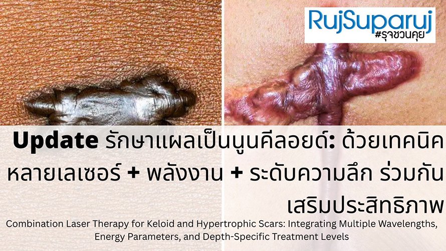Update รักษาแผลเป็นนูนคีลอยด์: ด้วยเทคนิคหลายเลเซอร์ + พลังงาน + ระดับความลึก ร่วมกันเสริมประสิทธิภาพ Combination Laser Therapy for Keloid and Hypertrophic Scars: Integrating Multiple Wavelengths, Energy Parameters, and Depth-Specific Treatment Levels