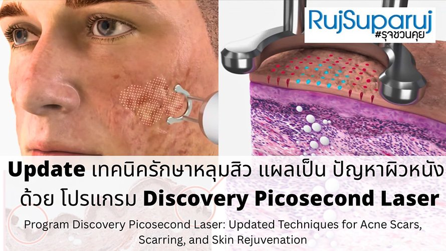 Update เทคนิครักษาหลุมสิวและแผลเป็นด้วย โปรแกรม Discovery Picosecond Laser