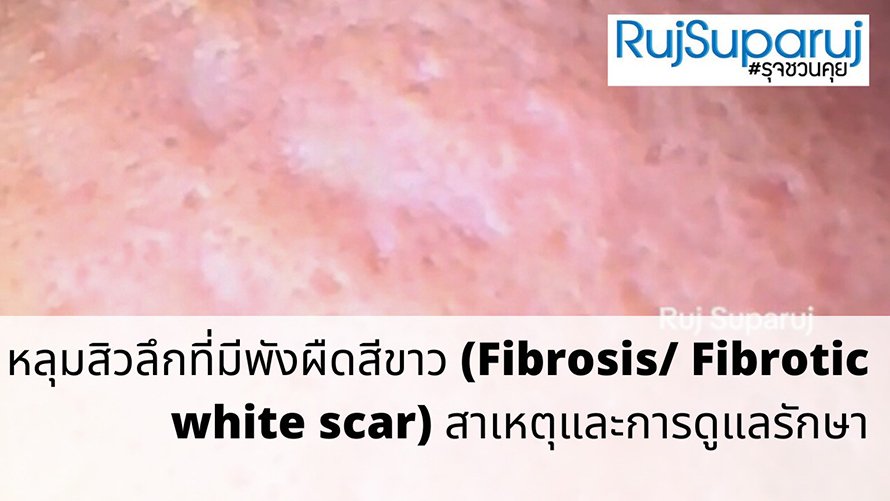 หลุมสิวลึกที่มีพังผืดสีขาว (Fibrosis/ Fibrotic white scar) สาเหตุและการดูแลรักษา