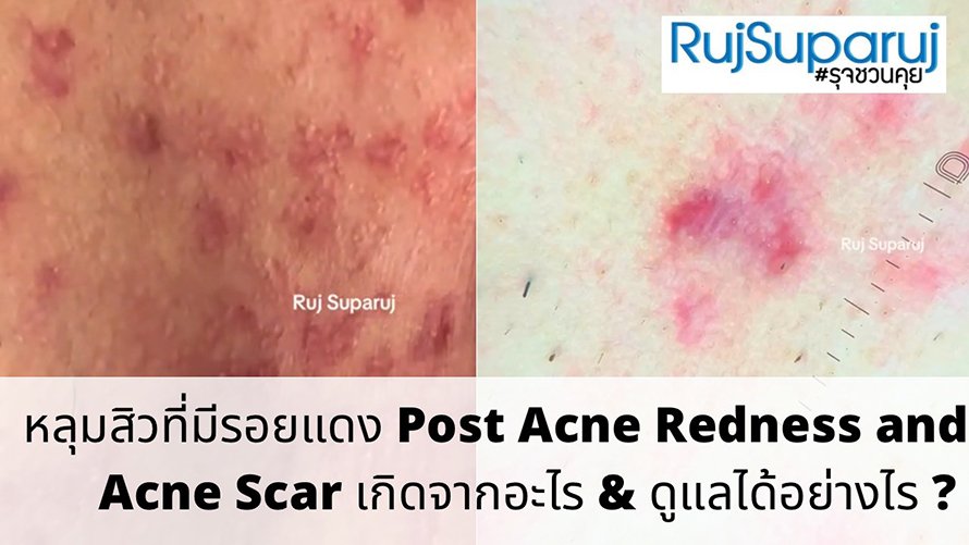 หลุมสิวที่มีรอยแดง Post Acne Redness and Acne Scar เกิดจากอะไร & ดูแลได้อย่างไร ?