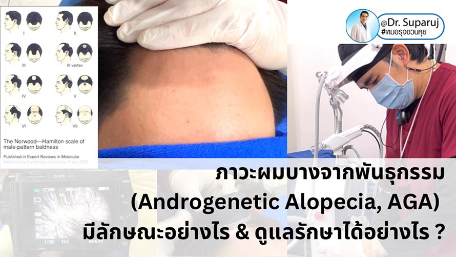 แนวทางการวินิจฉัยและรักษาภาวะผมบางจากพันธุกรรม (Androgenetic Alopecia)