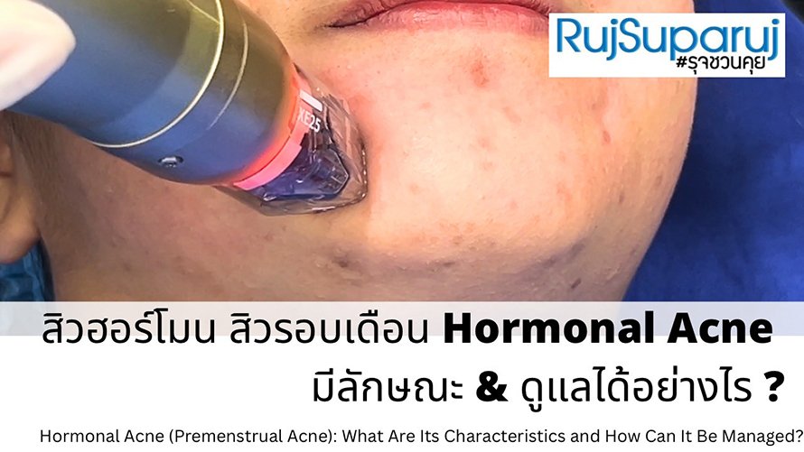 สิวฮอร์โมน สิวรอบเดือน Hormonal Acne มีลักษณะ & ดูแลได้อย่างไร ?