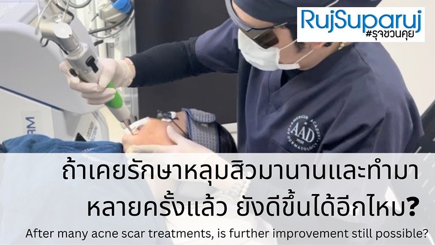ถ้าเคยรักษาหลุมสิวมานานและทำมาหลายครั้งแล้ว ยังดีขึ้นได้อีกไหม? After many acne scar treatments, is further improvement still possible?