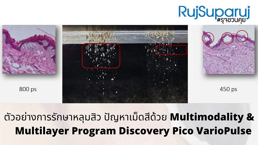 ตัวอย่างการรักษาหลุมสิว ปัญหาเม็ดสีด้วย Multimodality & Multilayer Program Discovery Pico VarioPulse