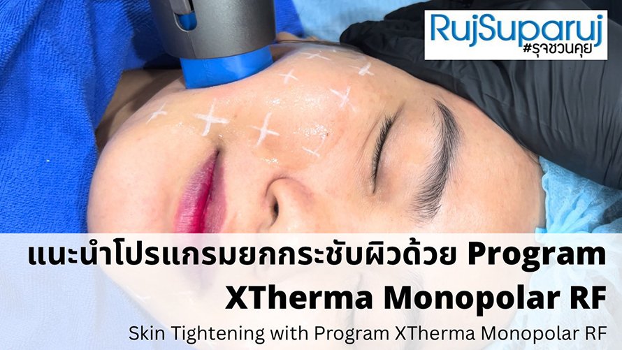 การดูแลความกระชับของผิวด้วย Program XTherma Monopolar RF