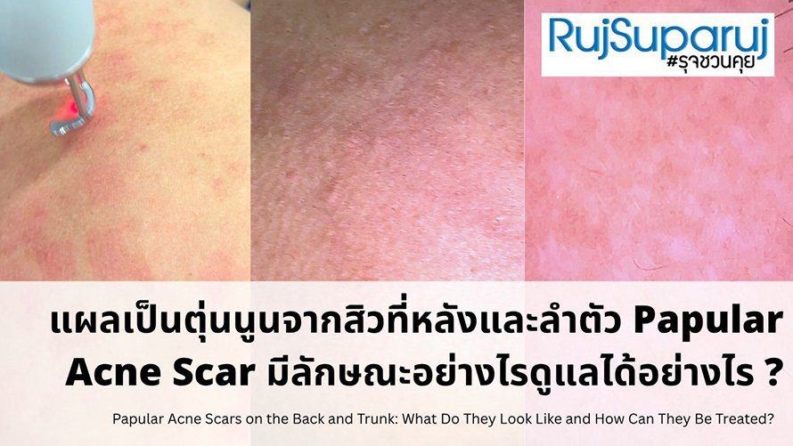แผลเป็นตุ่นนูนจากสิวที่หลังและลำตัว Papular Acne Scar มีลักษณะอย่างไรดูแลได้อย่างไร ?