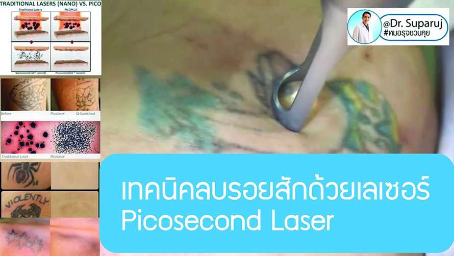 เทคนิคลบรอยสักด้วยเลเซอร์ Picosecond Laser