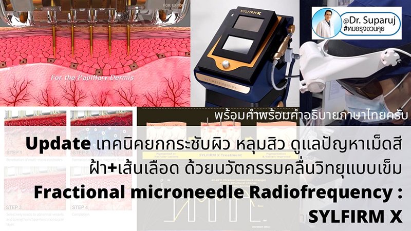 Update เทคนิคยกกระชับผิว หลุมสิว ดูแลปัญหาเม็ดสี ฝ้า+เส้นเลือด ด้วยนวัตกรรมคลื่นวิทยุแบบเข็ม Fractional microneedle Radiofrequency : SYLFIRM X Update เทคนิคยกกระชับผิว หลุมสิว ดูแลปัญหาเม็ดสี ฝ้า+เส้นเลือด ด้วยนวัตกรรมคลื่นวิทยุแบบเข็ม Fractional microneedle Radiofrequency : SYLFIRM X