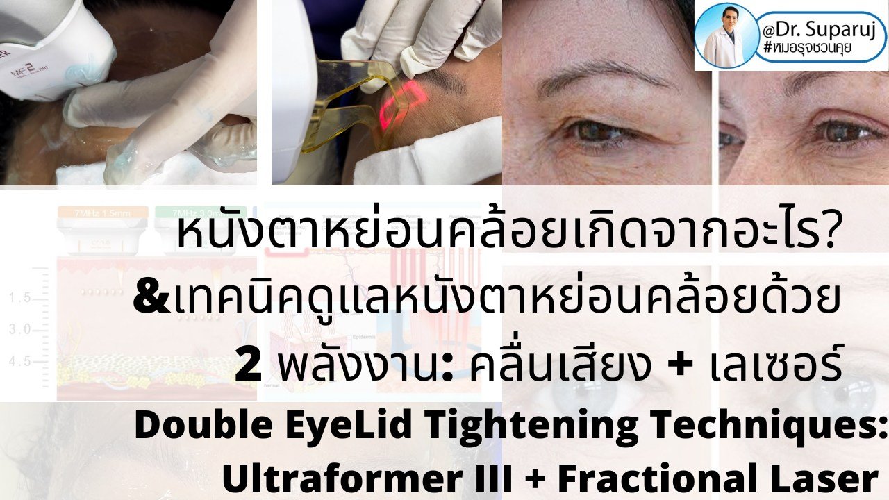 หนังตาหย่อนคล้อยเกิดจากอะไร & เทคนิคดูแลหนังตาหย่อนคล้อยโดยไม่ต้องผ่าตัด หนังตาหย่อนคล้อยเกิดจากอะไร & เทคนิคดูแลหนังตาหย่อนคล้อยโดยไม่ต้องผ่าตัด