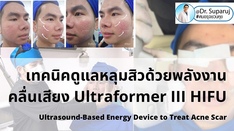 เทคนิคดูแลหลุมสิวด้วยพลังงานคลื่นเสียง Ultraformer III HIFU (Ultrasound-Based Energy Device to Treat Acne Scar)  เทคนิคดูแลหลุมสิวด้วยพลังงานคลื่นเสียง Ultraformer III HIFU (Ultrasound-Based Energy Device to Treat Acne Scar)