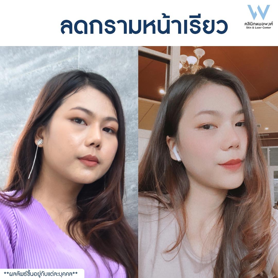 คุณบ๊วย - คอร์สลดกรามหน้าเรียว