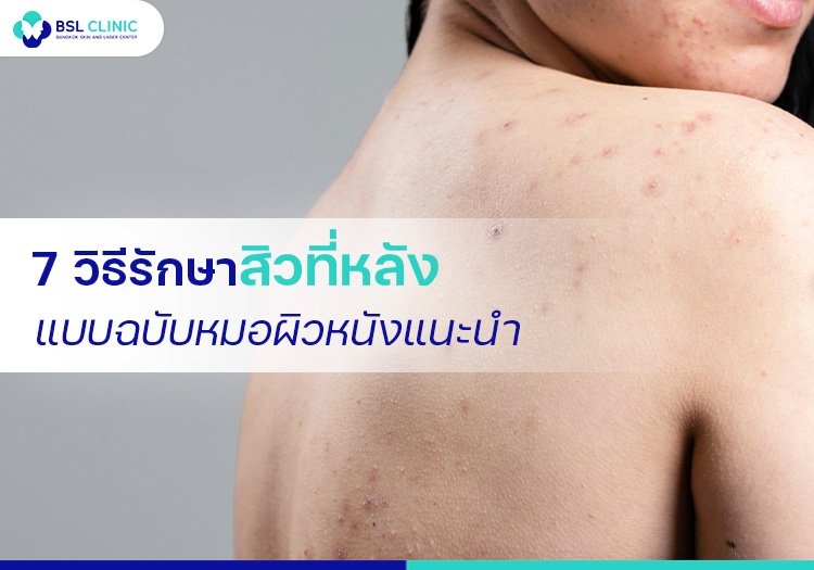 7 วิธีรักษาสิวที่หลัง แบบฉบับหมอผิวหนังแนะนำ