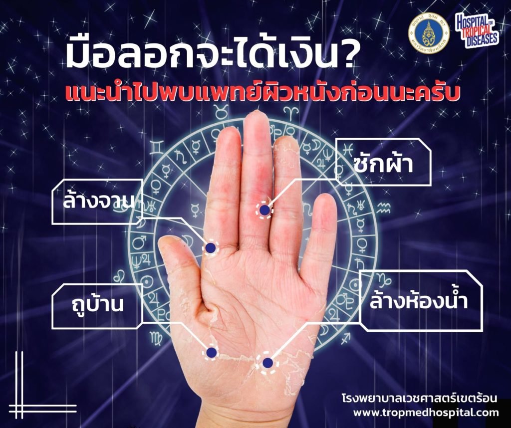 โรคมือลอก (Hand Eczema)