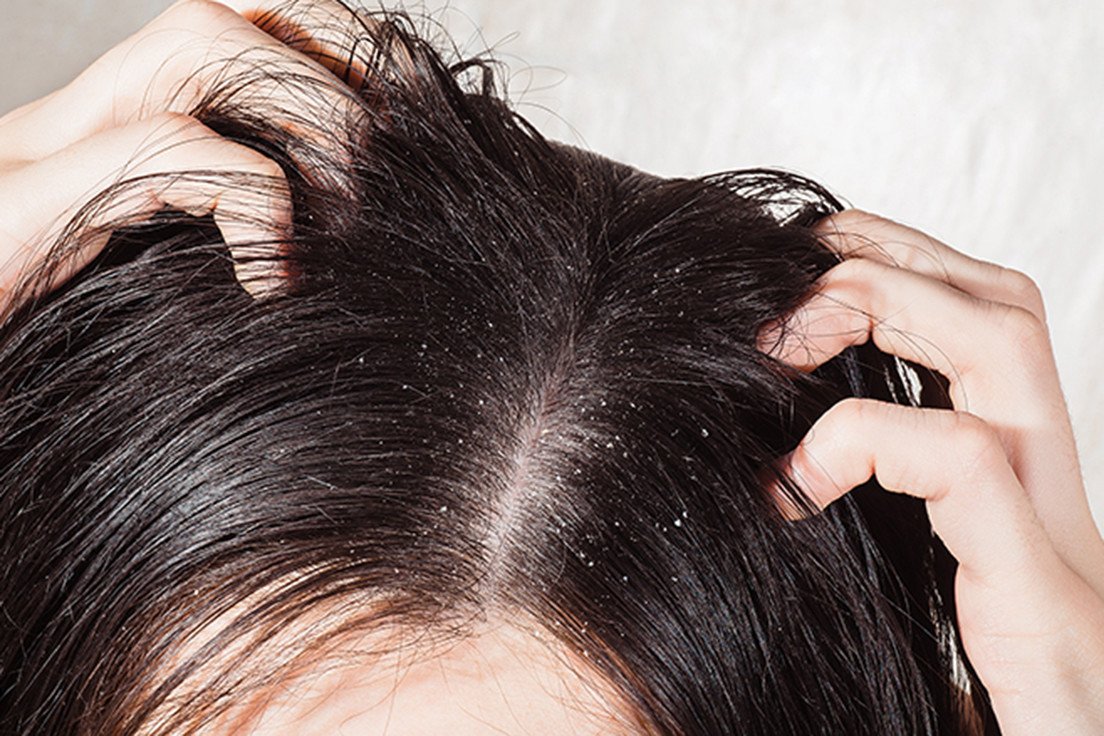 รังแค รังแค