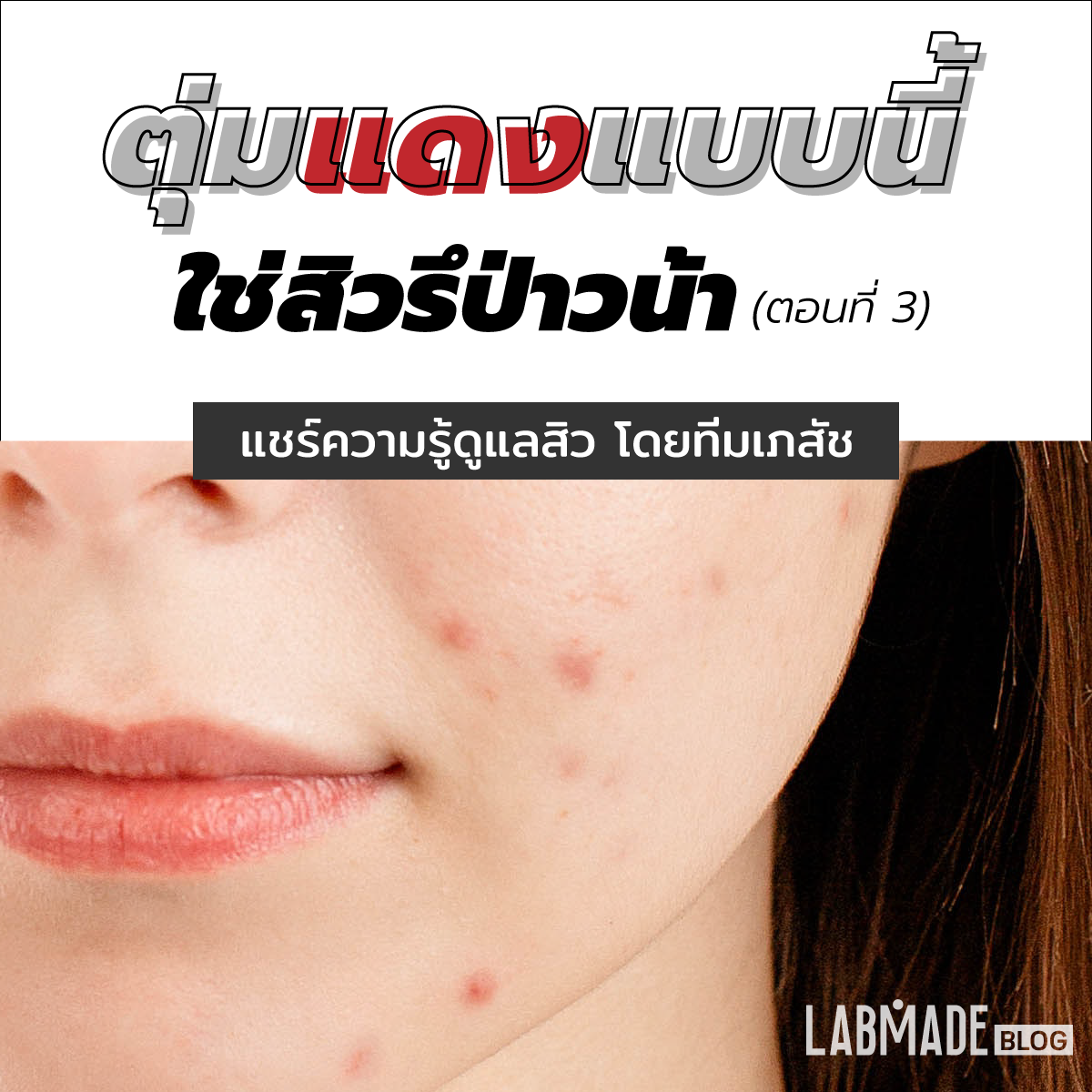 ตุ่มแดงๆแบบนี้ ใช่สิวรึป่าวน้า….? (ตอนที่ 3) ตุ่มแดงๆแบบนี้ ใช่สิวรึป่าวน้า….? (ตอนที่ 3)