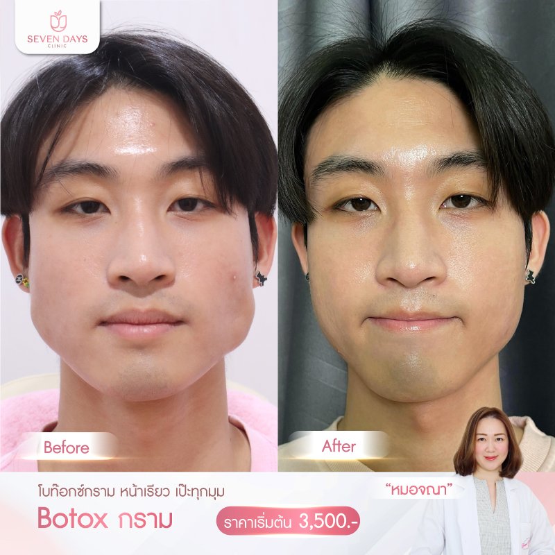 รีวิว Botox