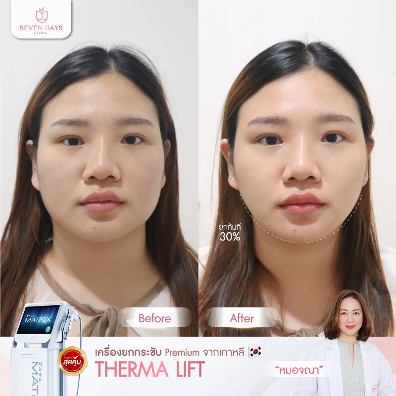 รีวิว Therma Lift